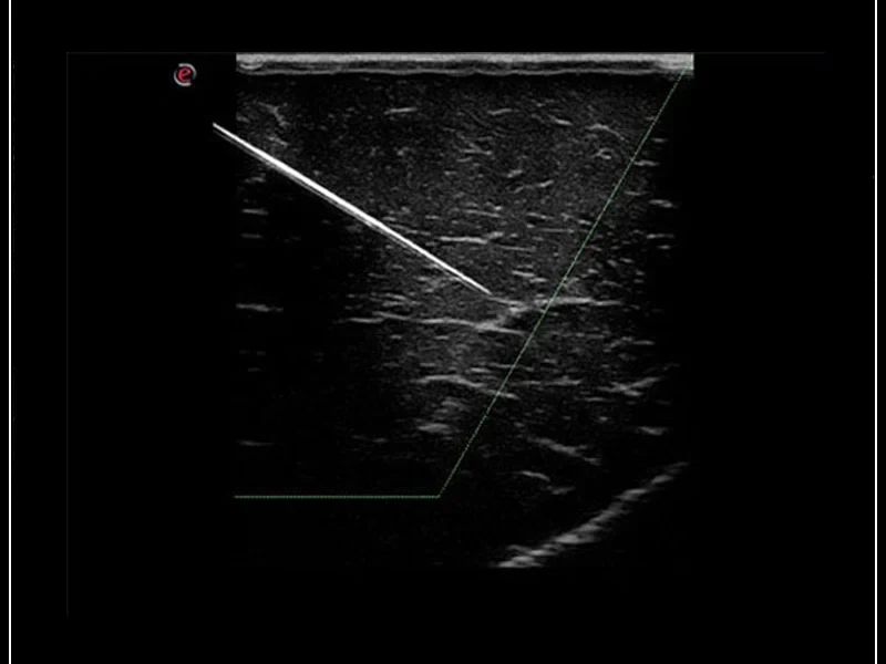 MyLab™Omega — wizualizacja końcówki igły (Needle Enhancement)