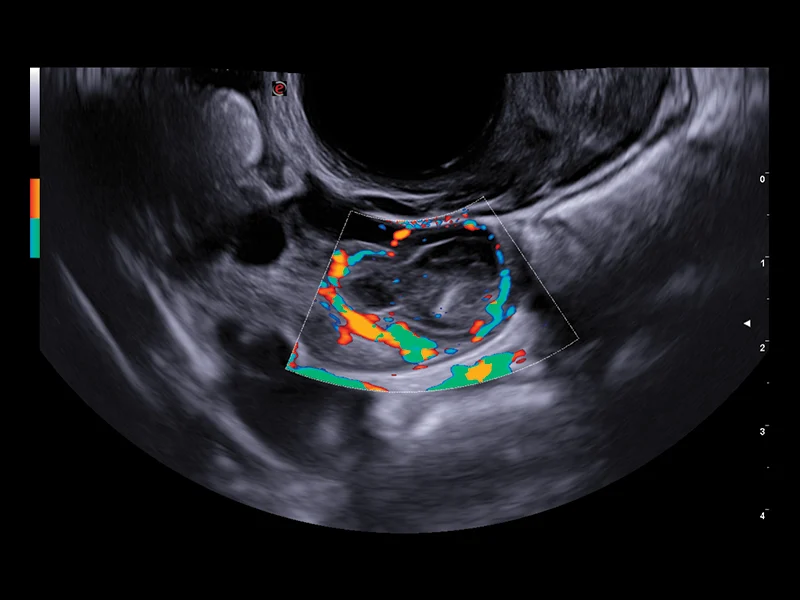 Gynaecology clinical image