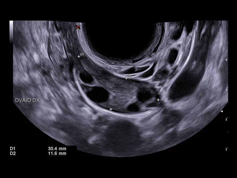 Gynaecology clinical image