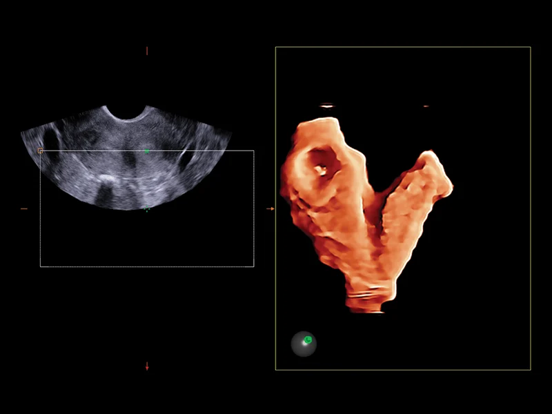 Gynaecology clinical image