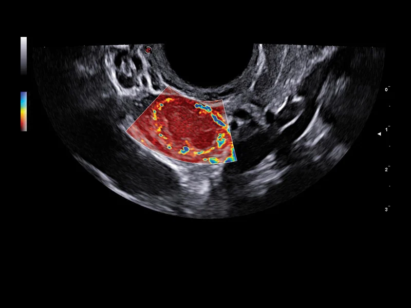 Gynaecology clinical image