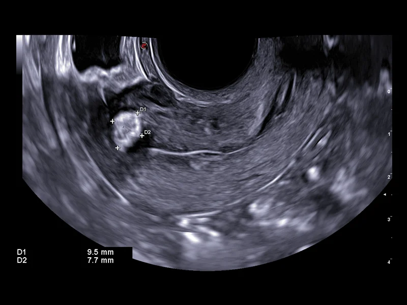 Gynaecology clinical image